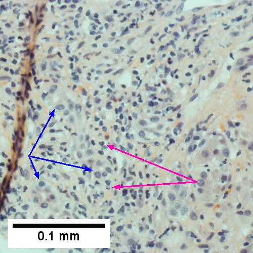 Proliferating bile ductules (blue arrows) with occasional neutrophils (fucsia arrows), indicative of obstruction, but not acute cholangitis, which requires inflamed bile duct itself, best diagnosed with associated blood vessel (400X).