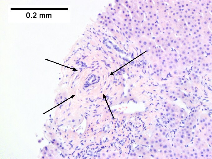 Primary sclerosing cholangitis in patient with history of ulcerative colitis.