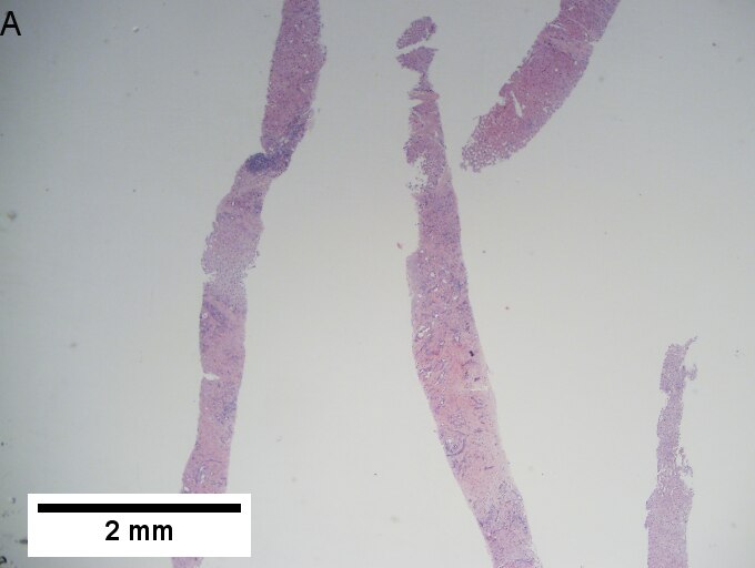 Alpha 1 anti-trypsin (A1AT) granules in cirrhosis, not due to A1AT deficiency; A1AT level was normal.