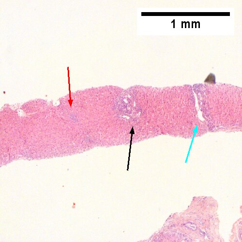 HCR. Metavir Activity Index 2 (PMN 1 LN 2) Metavir fibrosis stage 3.