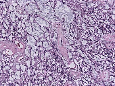 Myxopapillary ependymoma-HE.jpg