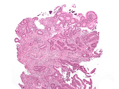 Cecal adenocarcinoma.jpg