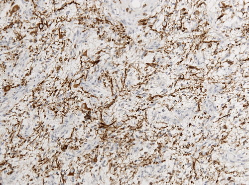 Neuropathology case V 06.jpg