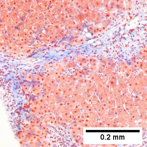 HCR. Metavir Activity Index 2 (PMN 1 LN 2) Metavir fibrosis stage 3.