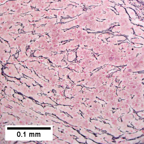 Reticulin shows regeneration [two nuclei thick cords between black lines] (400X)