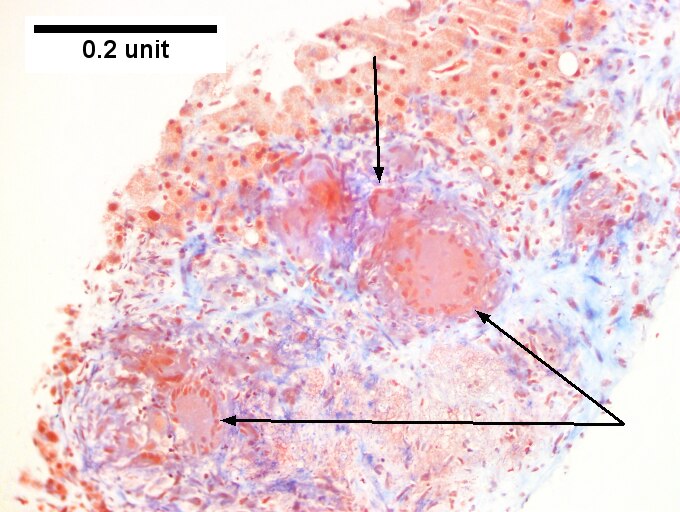 Hepatic sarcoidosis in a patient with previously known sarcoidosis.