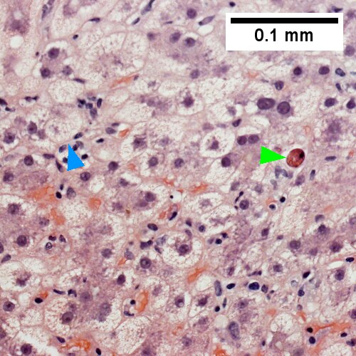 Disordered, often swollen hepatocytes,some with feathery degeneration (net like spaces in cytoplasm [blue arrowhead], rare Councilman body [green arrowhead] (400X)