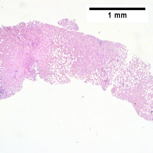 Steatohepatitis. Brunt necroinflammatory grade 2. Brunt fibrosis stage 2.