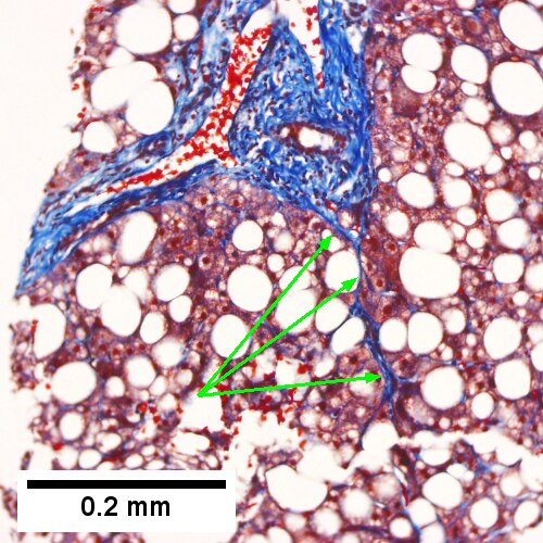 Trichrome shows a bridge (arrows) (Row 3 Right 200X).