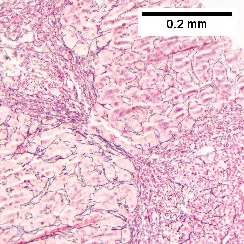 HCR. Metavir Activity Index 2 (PMN 1 LN 2) Metavir fibrosis stage 3.