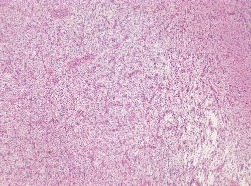 Neuropathology case V 01.jpg