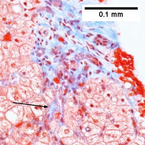 Steatohepatitis. Brunt necroinflammatory grade 2. Brunt fibrosis stage 2.