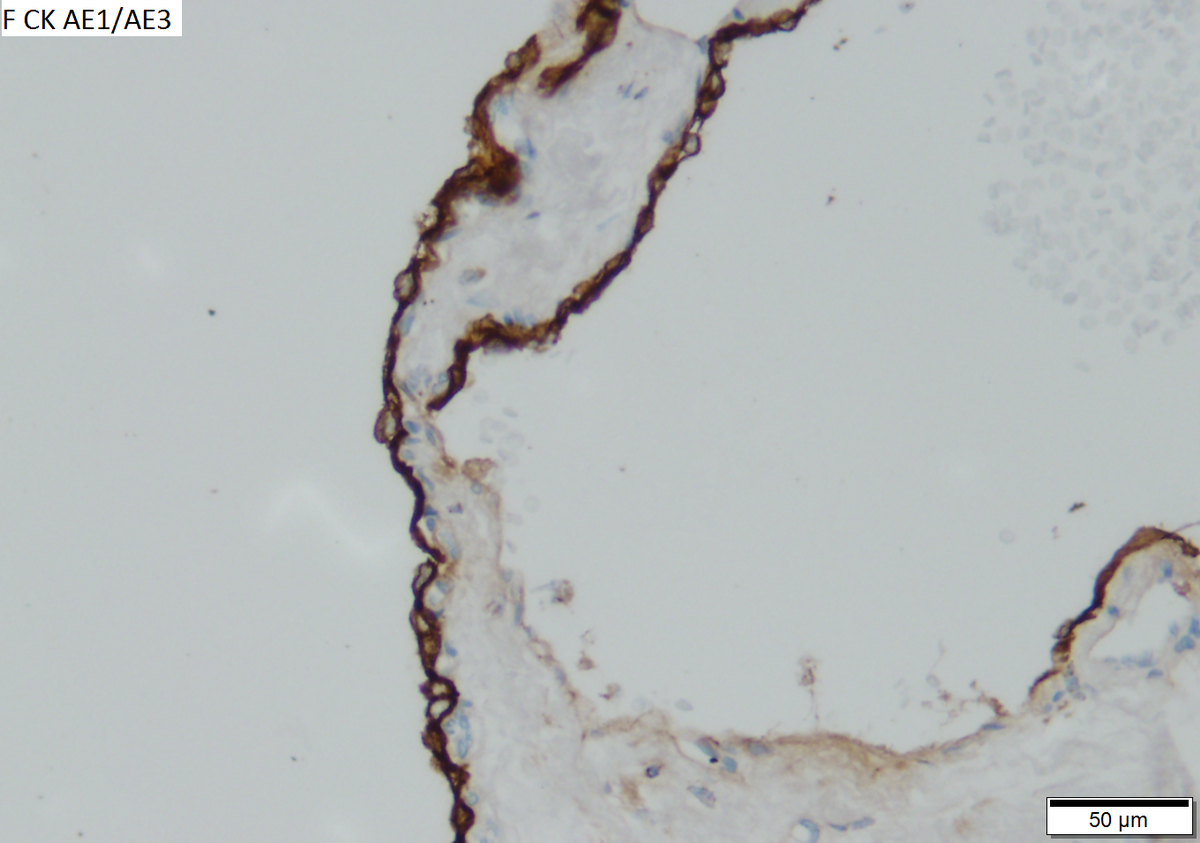 Microcystic serous cystadenoma of pancreas