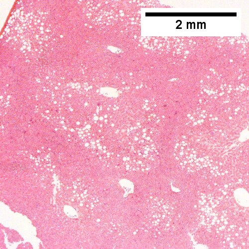 Steatohepatitis. Brunt necroinflammatory grade 1. Brunt fibrosis stage 1.