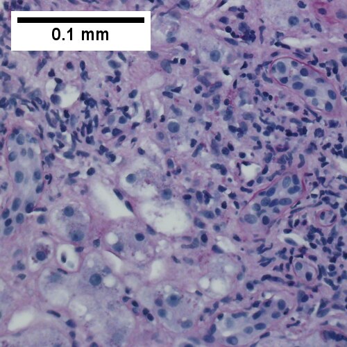 PAS with diastase shows bile duct/proliferating bile ductules with epithelial injury and hepatocytes with ballooning degeneration (400X).