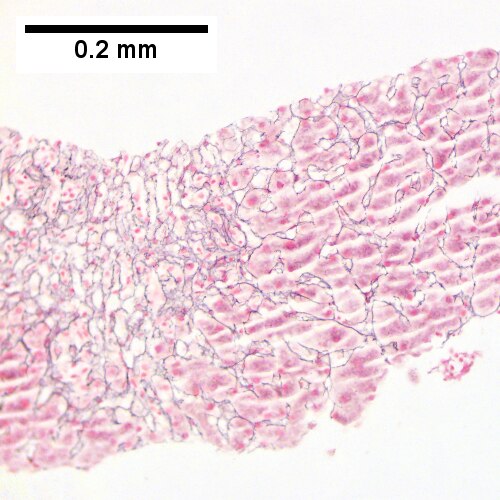 Submassive hepatic necrosis.