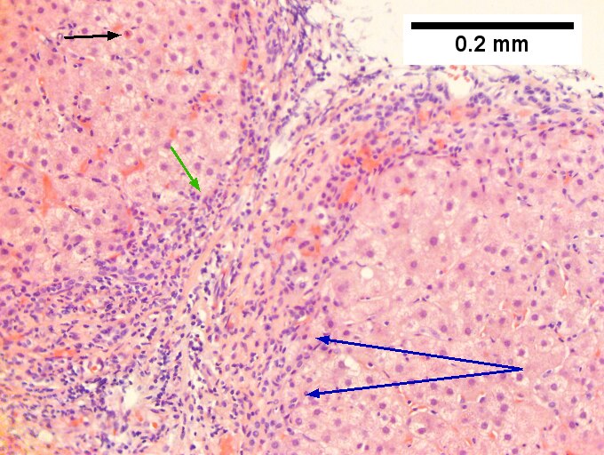 Hepatitis C virus. Metavir activity index 3 (PMN 2, LN 2). Metavir stage 4 (cirrhosis, definite by old criteria).