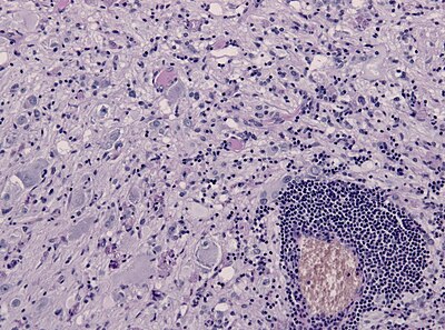 Ganglioglioma lymphocytic cuffing PAS.jpg