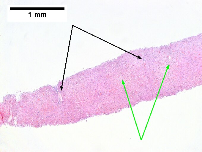 Hemocrhomatosis with DILI canalicular cholestasis with mild hepatocyte injury in the form of regeneration.